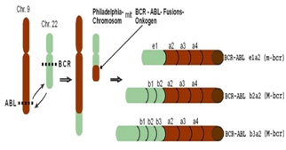 Molekularbiologischer Nachweis der BCR-ABL-Genrearrangements bei Leukämien